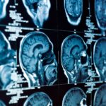 Understanding The Role Of A Brain Injury Lawyer