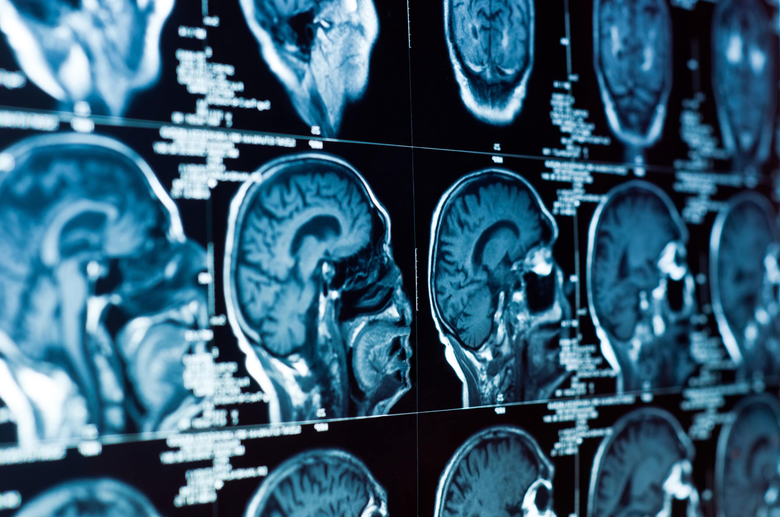 Read more about the article Understanding The Role Of A Brain Injury Lawyer